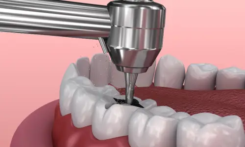 3D illustration of a root canal in Carmichael being performed to remove infection from a tooth at Mission Dental.