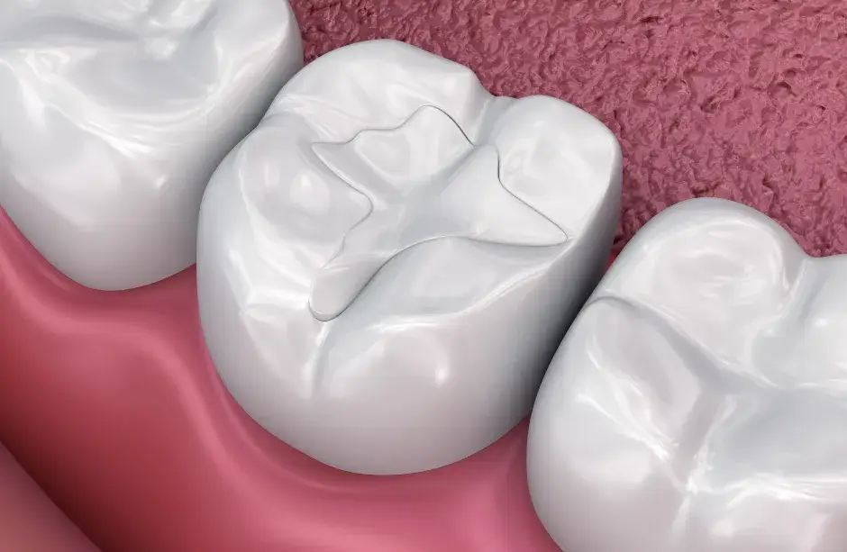 tooth filling in Carmichael