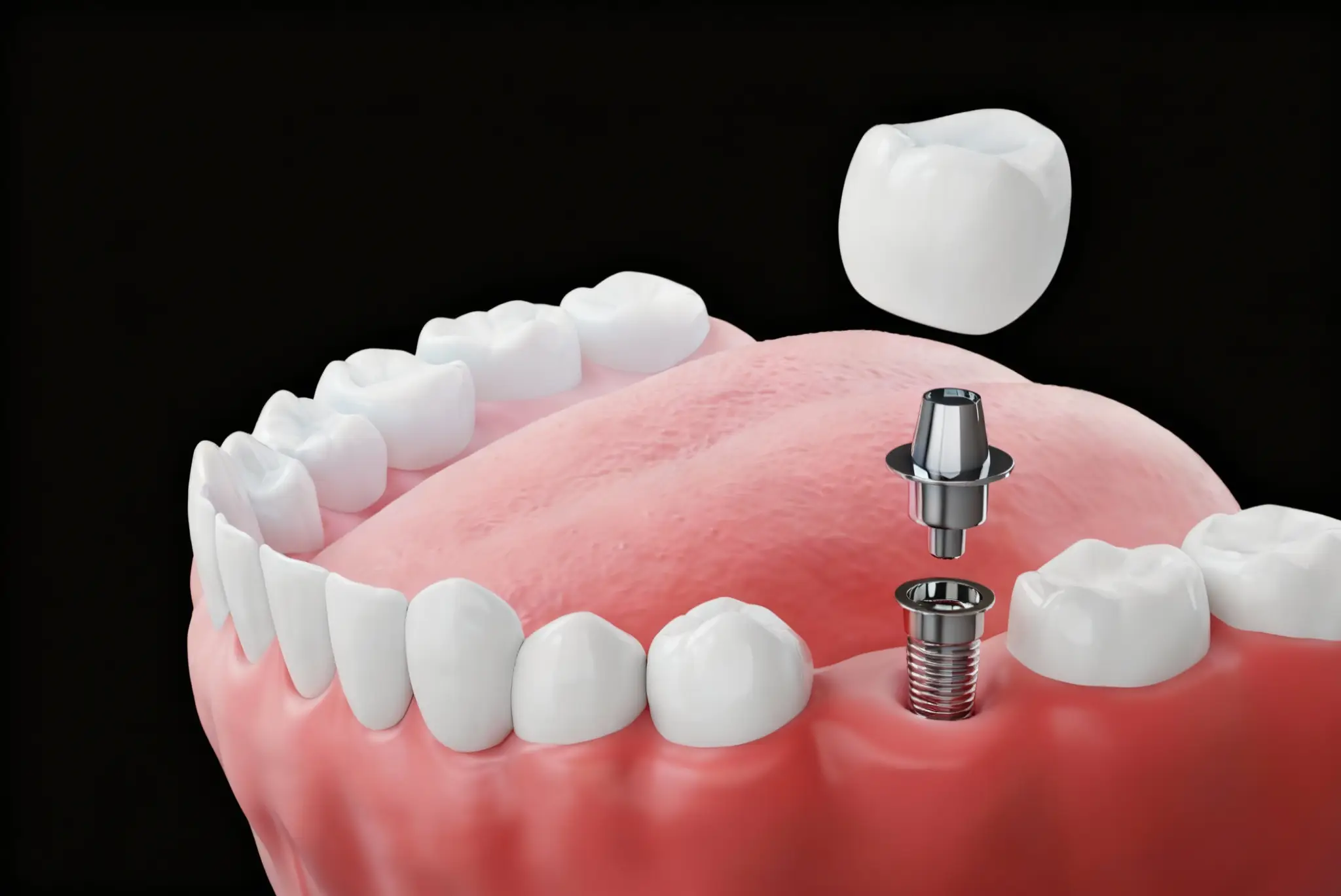 Dental Implants in Carmichael