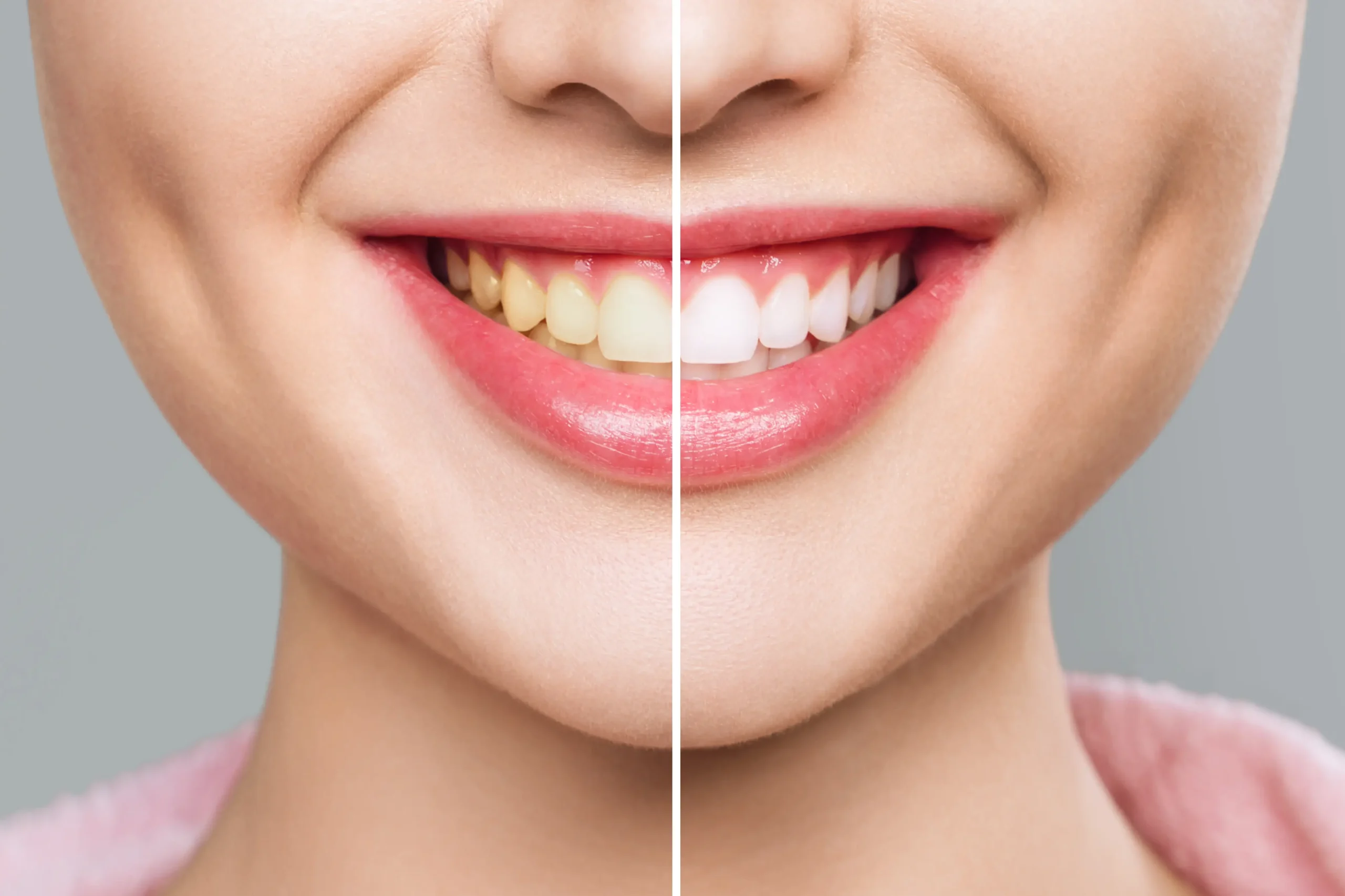 Tooth Whitening Carmichael | Mission Dental
