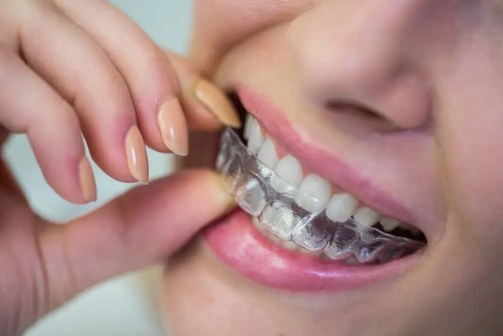Invisalign clear aligners near Fair Oaks CA Mission Dental