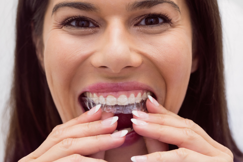 Invisalign clear aligners near Roseville CA Mission Dental